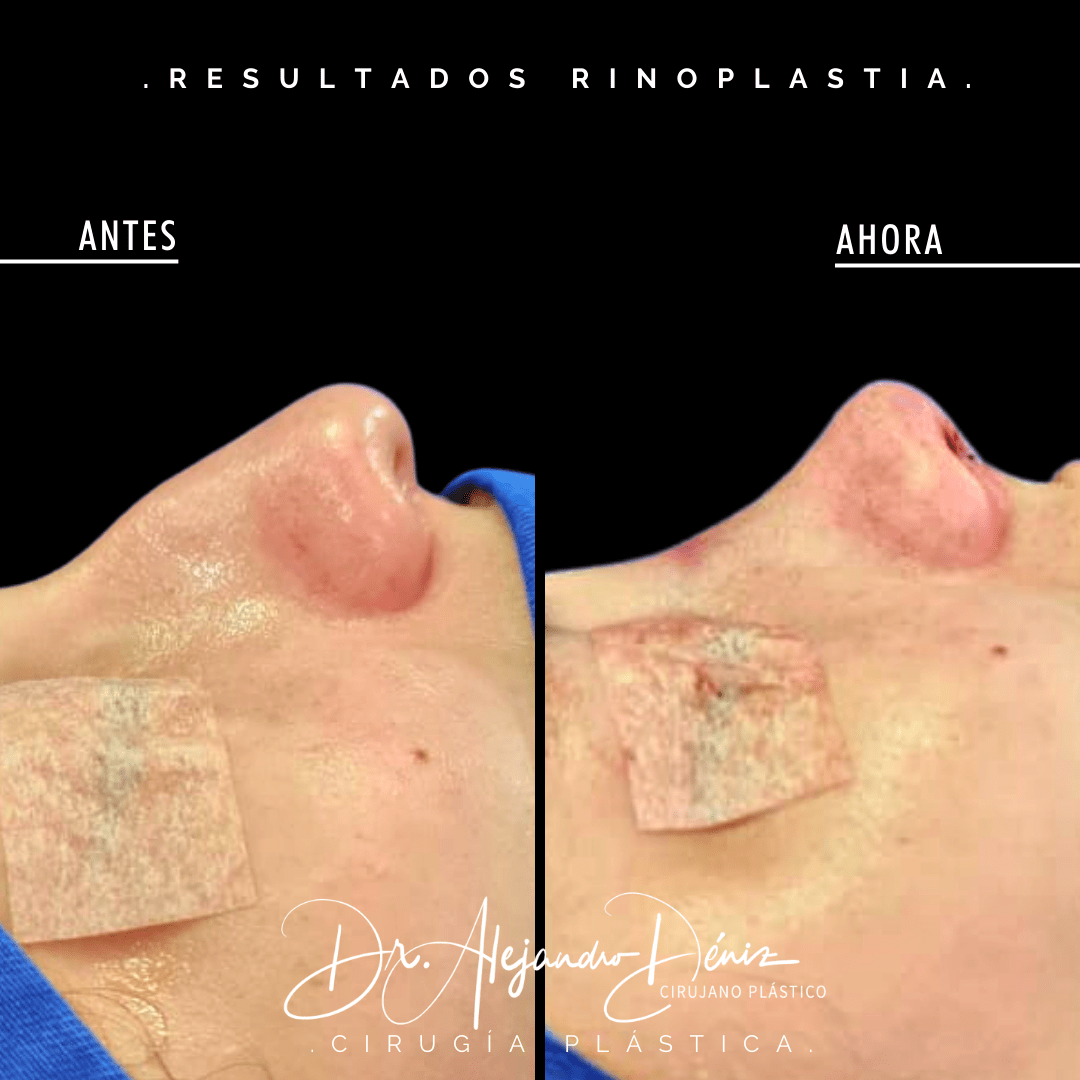 RINOPLASTIA (3)