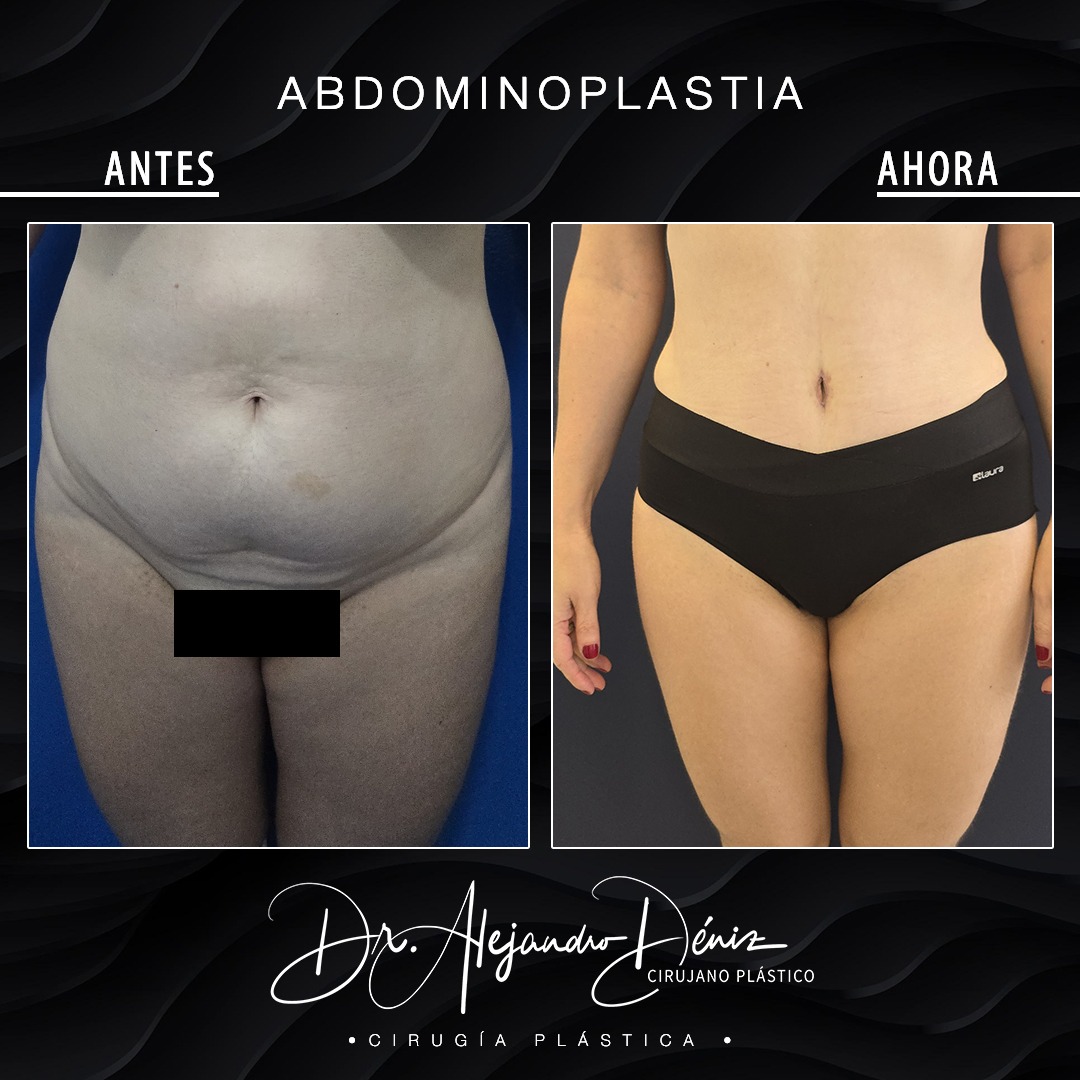 ABDOMINOPLASTIA_1