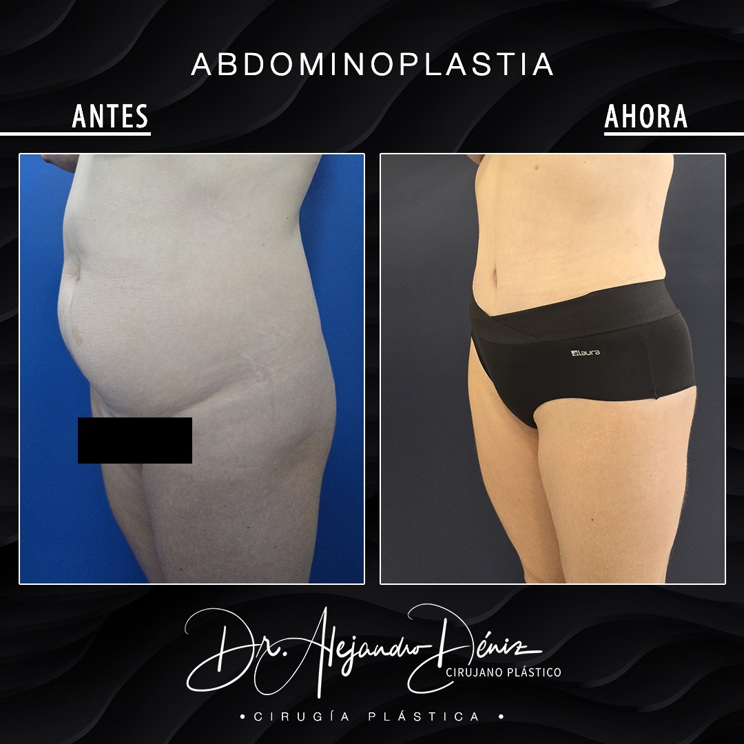 ABDOMINOPLASTIA_2