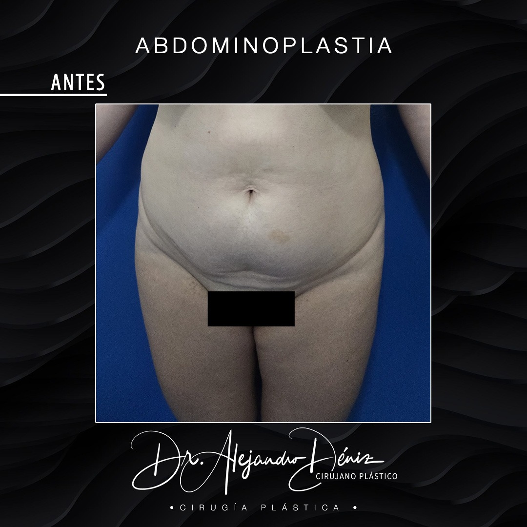 ABDOMINOPLASTIA_3