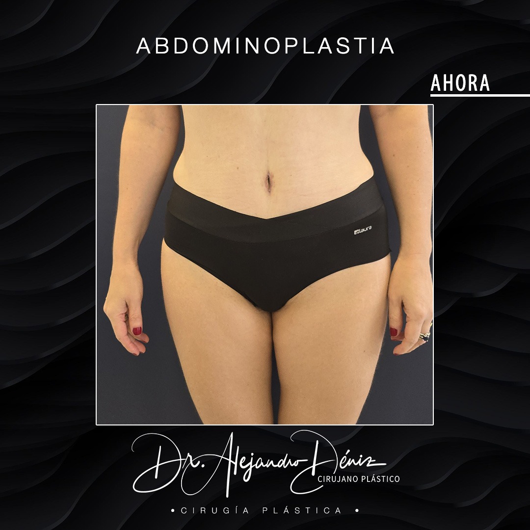 ABDOMINOPLASTIA_4
