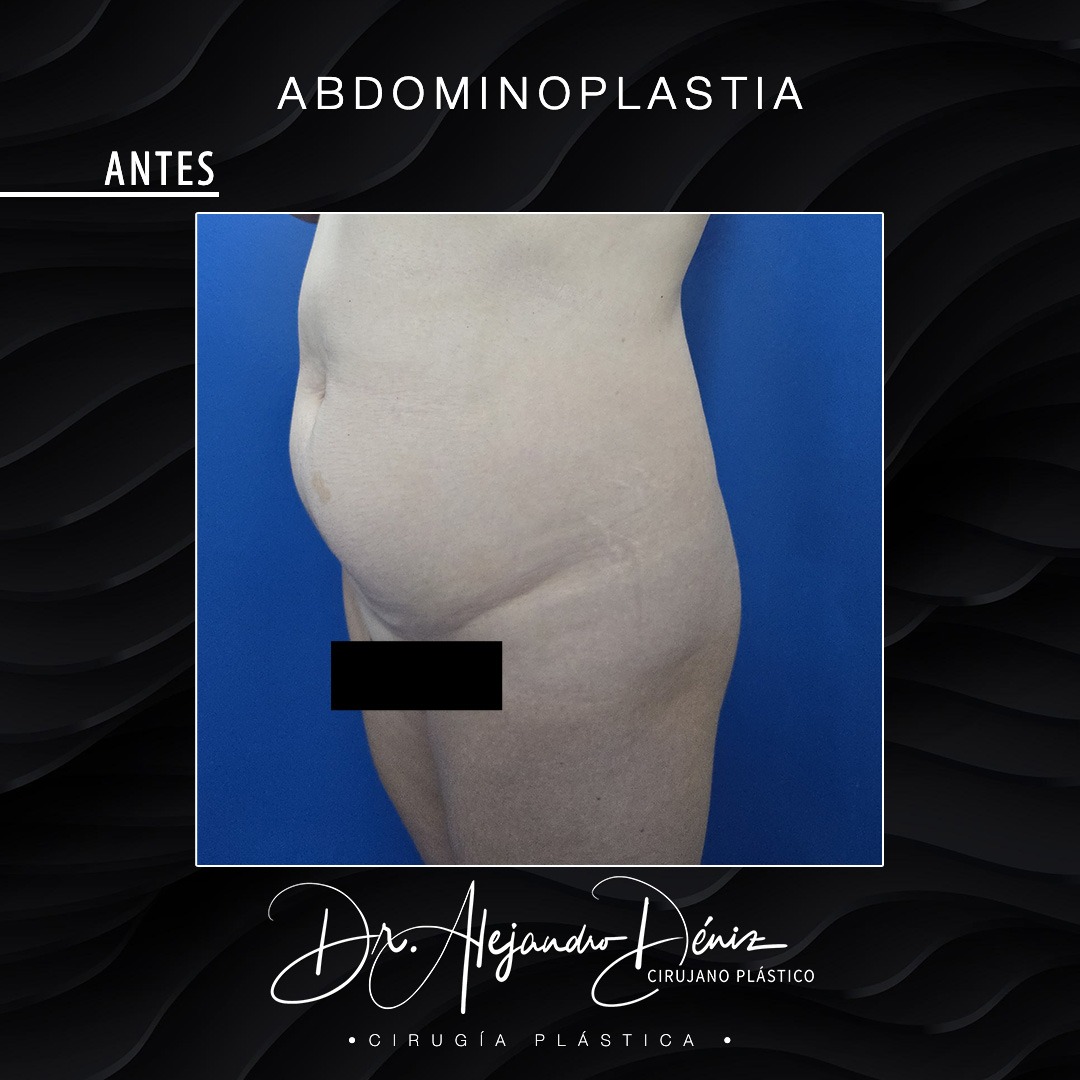 ABDOMINOPLASTIA_5