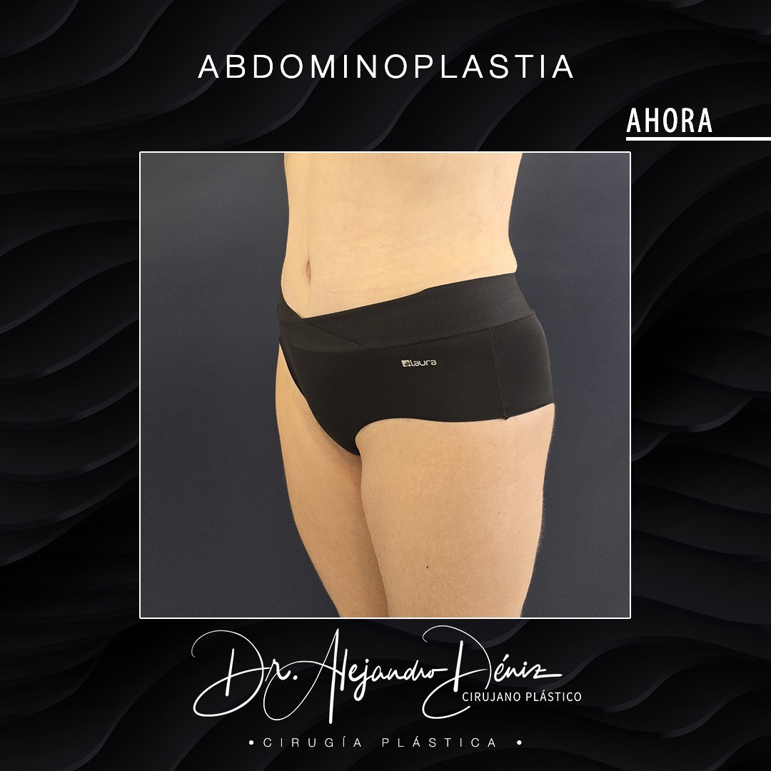 ABDOMINOPLASTIA_6