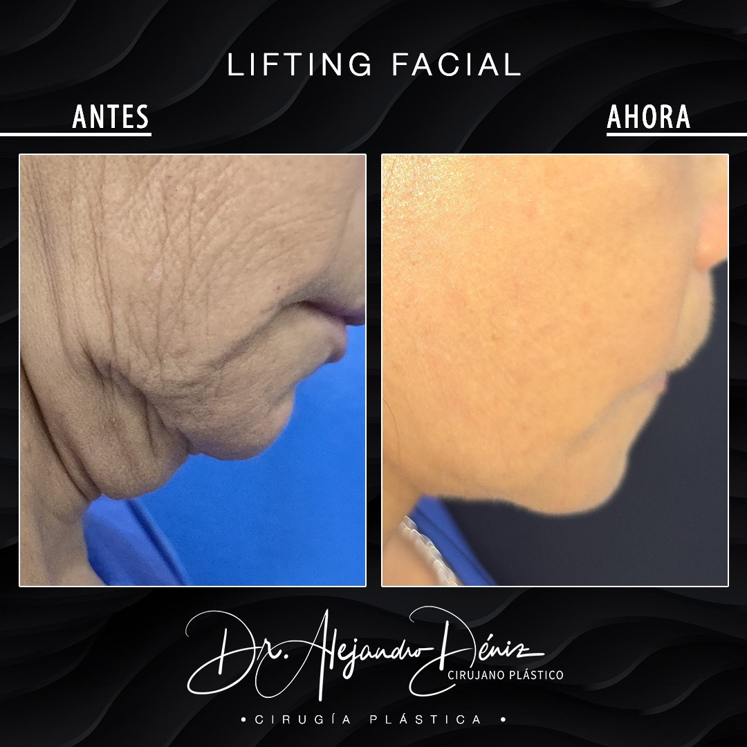 LIFTING FACIAL_1