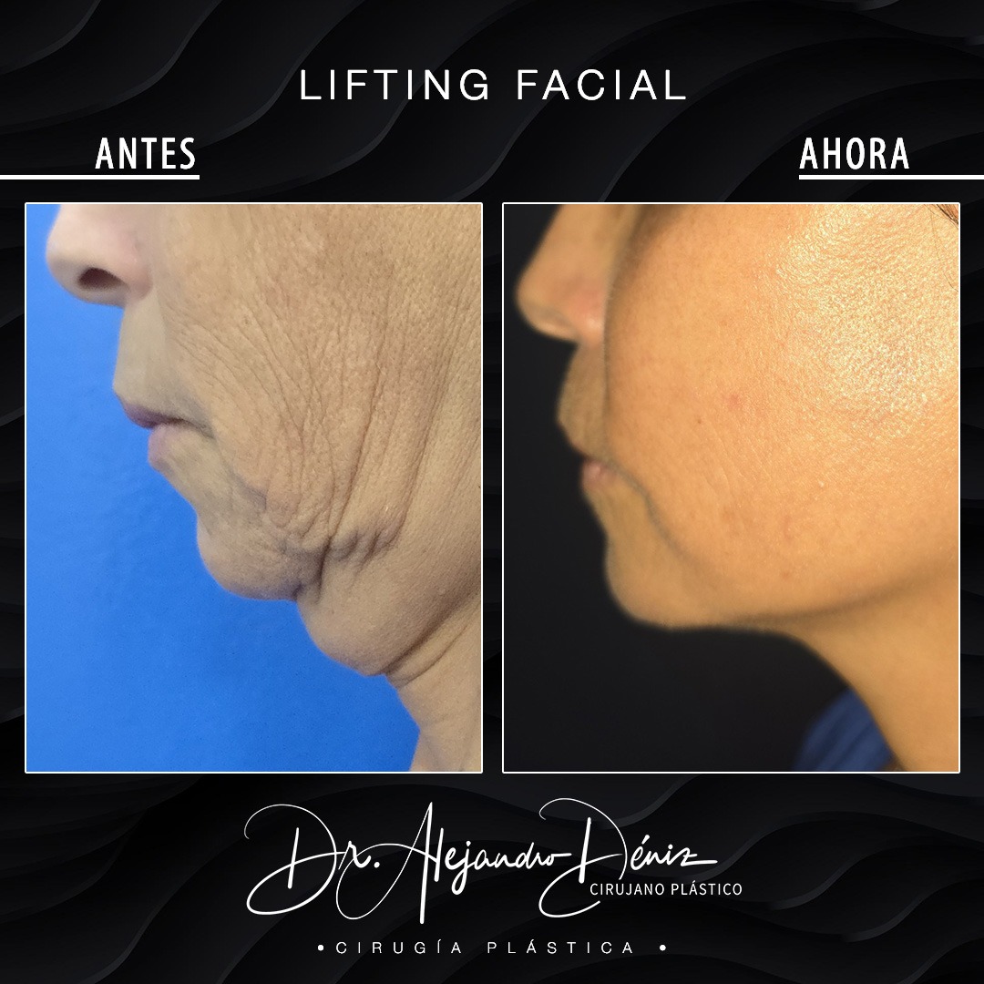 LIFTING FACIAL_2