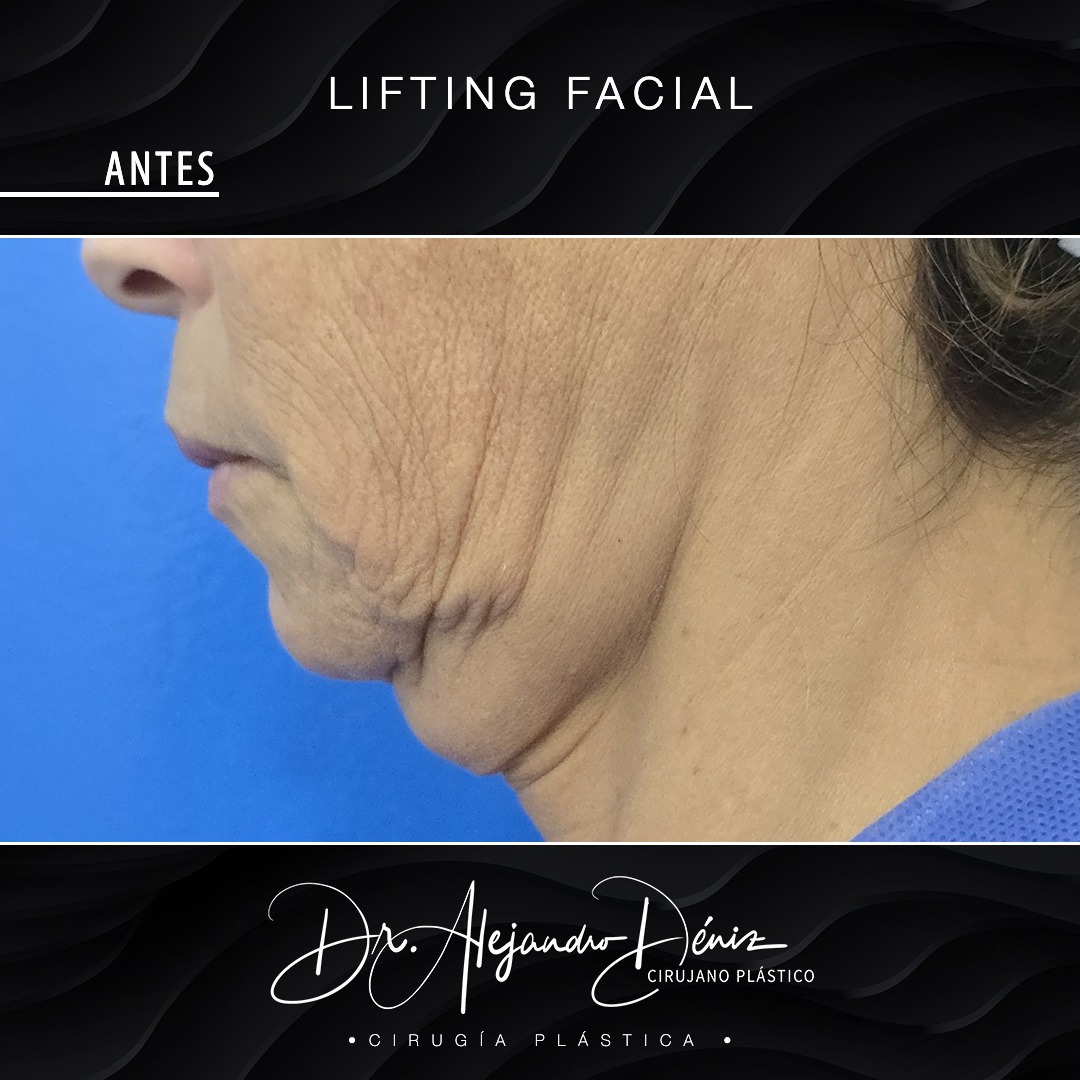 LIFTING FACIAL_3
