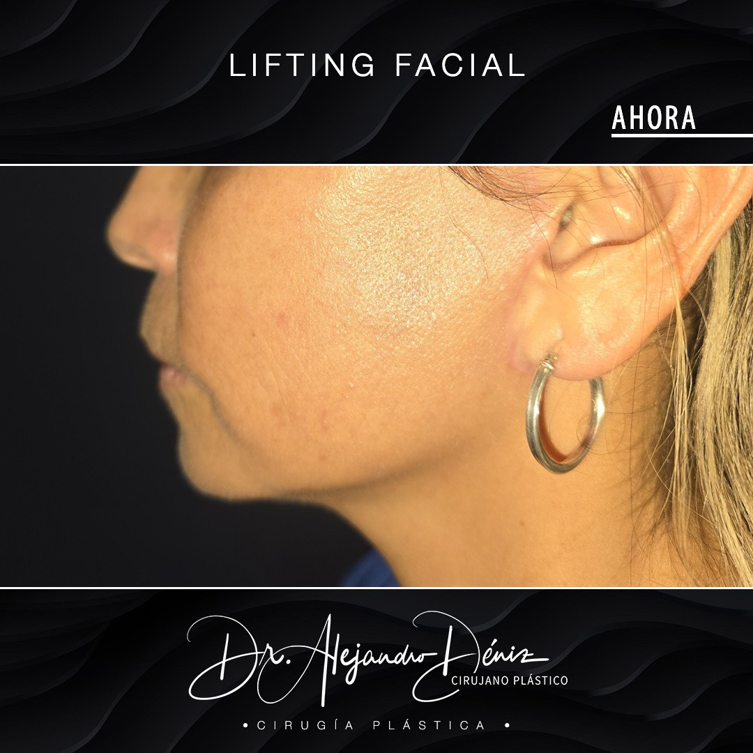 LIFTING FACIAL_4