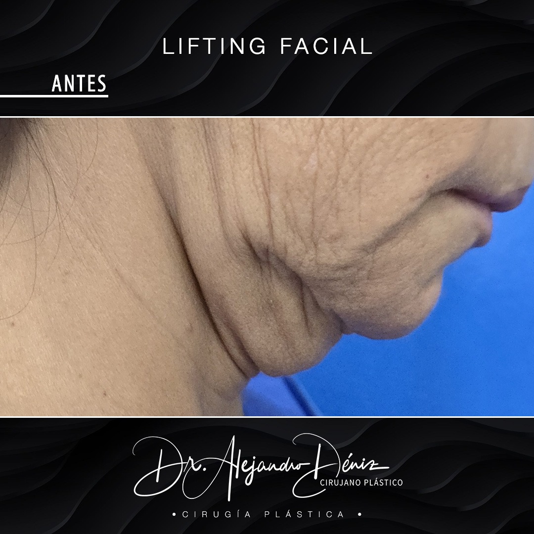 LIFTING FACIAL_5