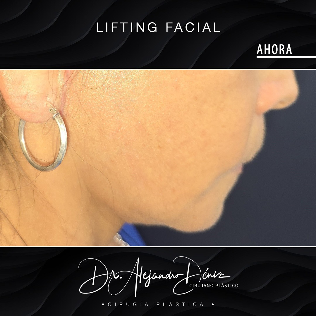 LIFTING FACIAL_6
