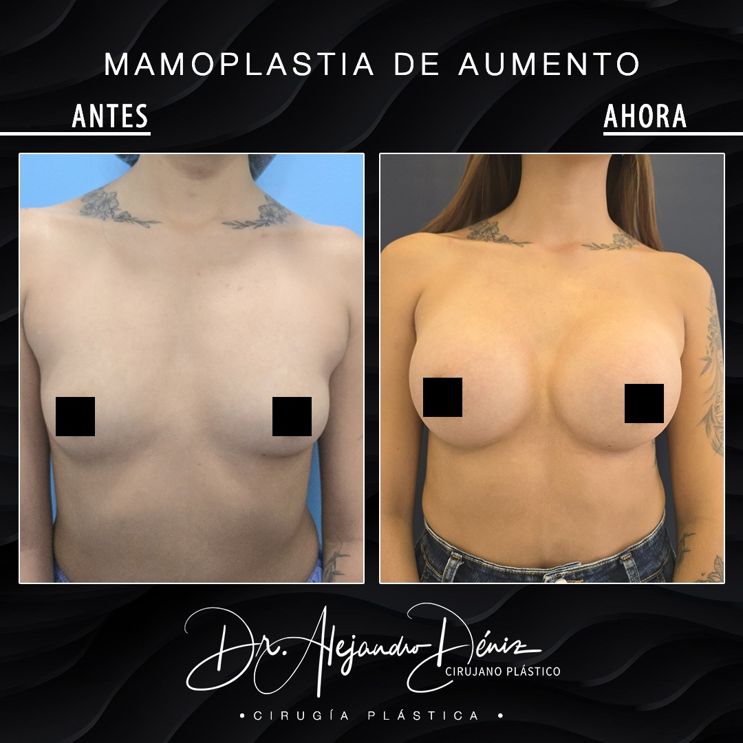 MAMOPLASTIA DE AUMENTO_1