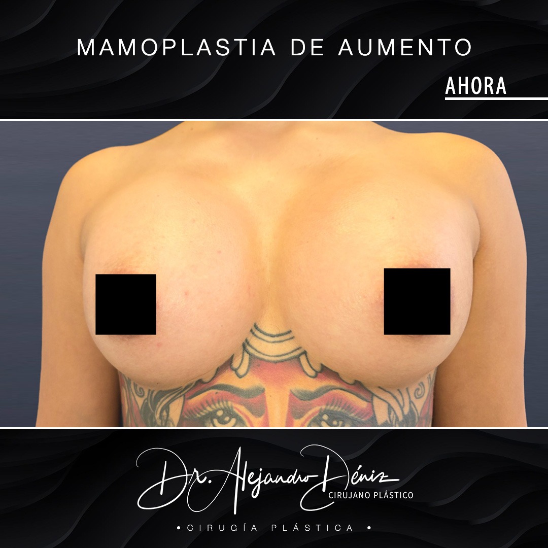 MAMOPLASTIA DE AUMENTO_10
