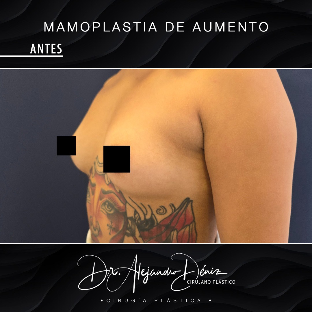 MAMOPLASTIA DE AUMENTO_11