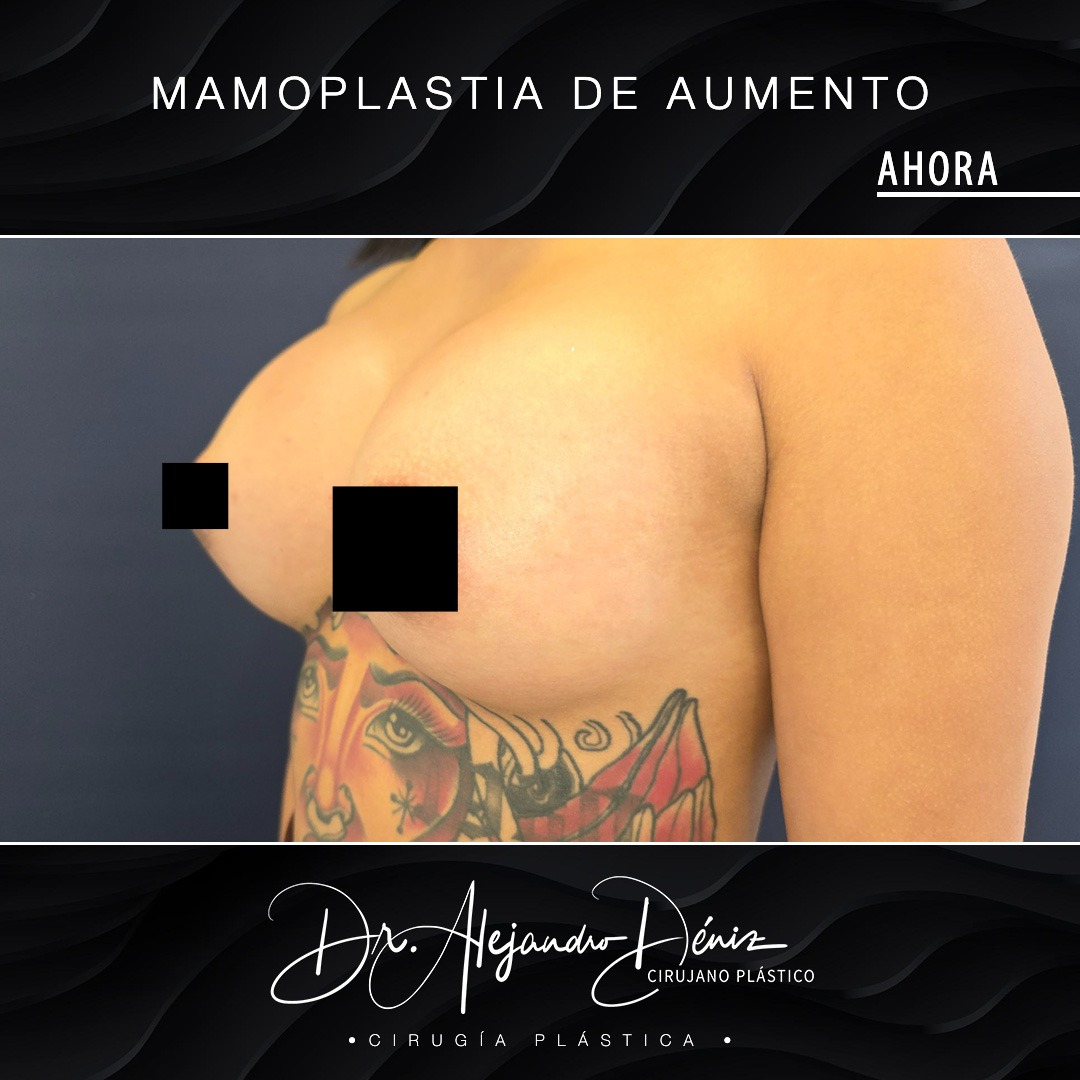 MAMOPLASTIA DE AUMENTO_12
