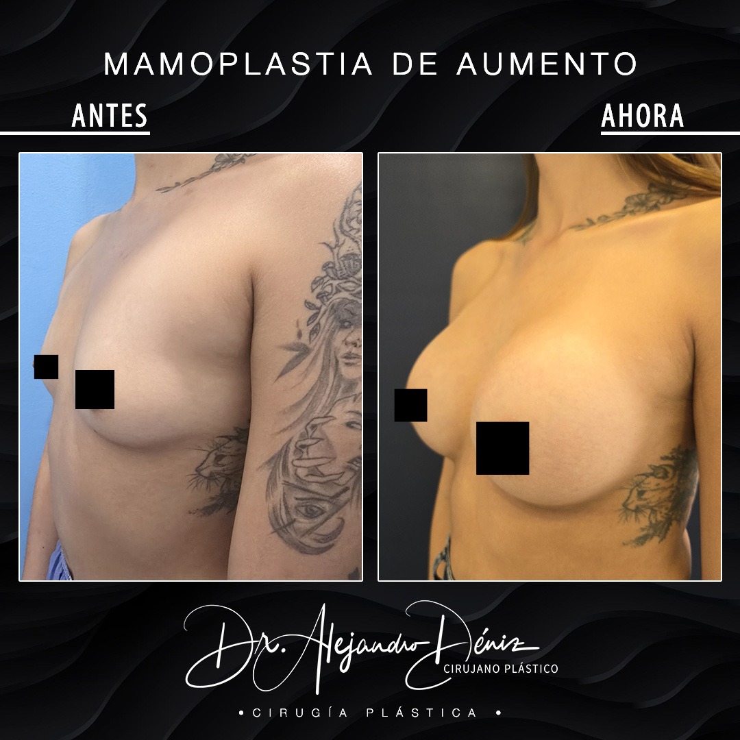 MAMOPLASTIA DE AUMENTO_2