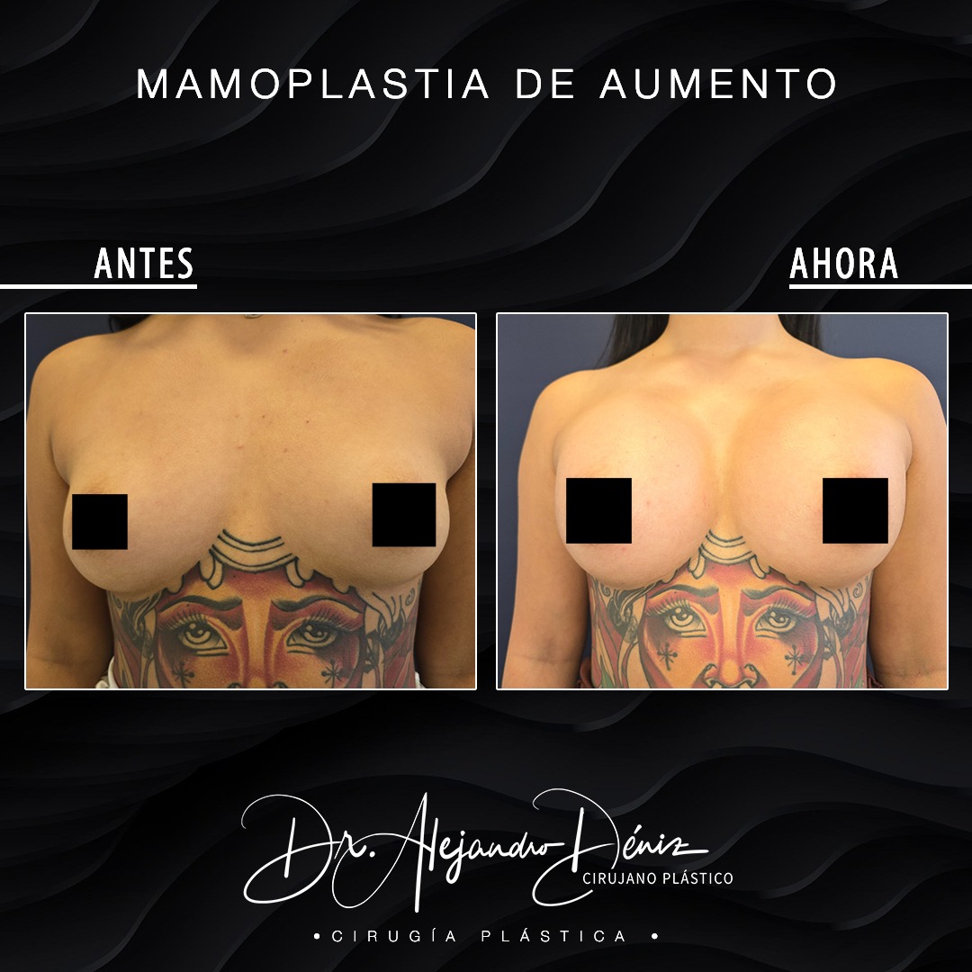 MAMOPLASTIA DE AUMENTO_3