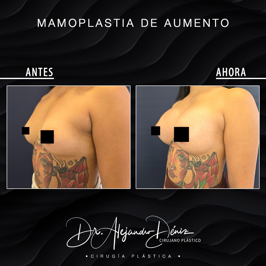 MAMOPLASTIA DE AUMENTO_4