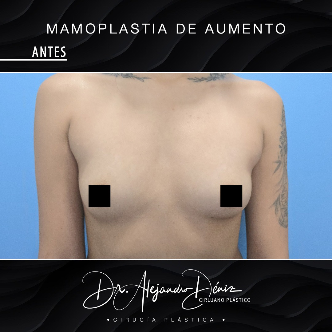 MAMOPLASTIA DE AUMENTO_5