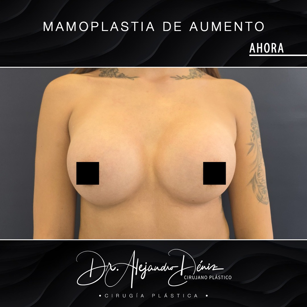 MAMOPLASTIA DE AUMENTO_6
