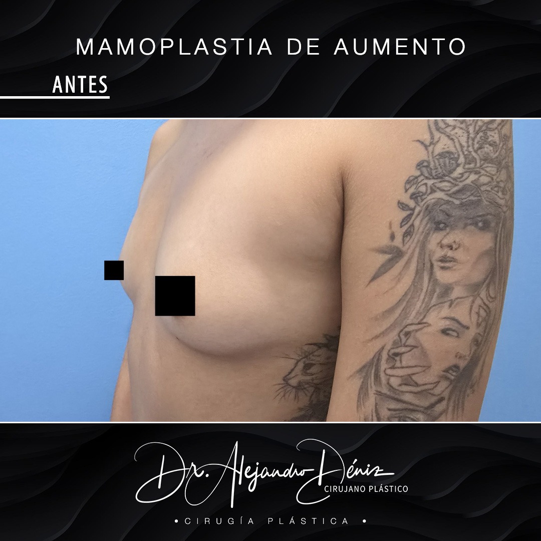 MAMOPLASTIA DE AUMENTO_7