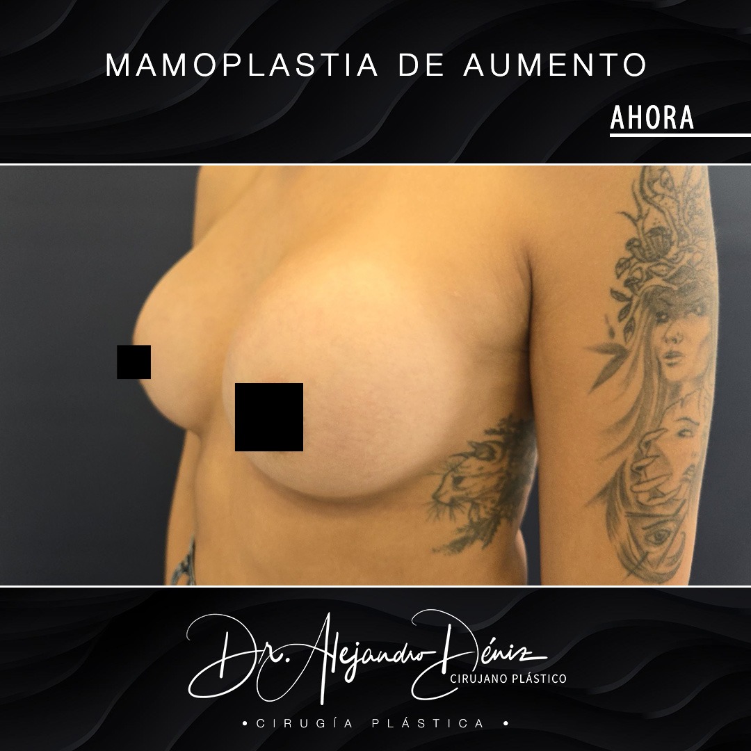 MAMOPLASTIA DE AUMENTO_8