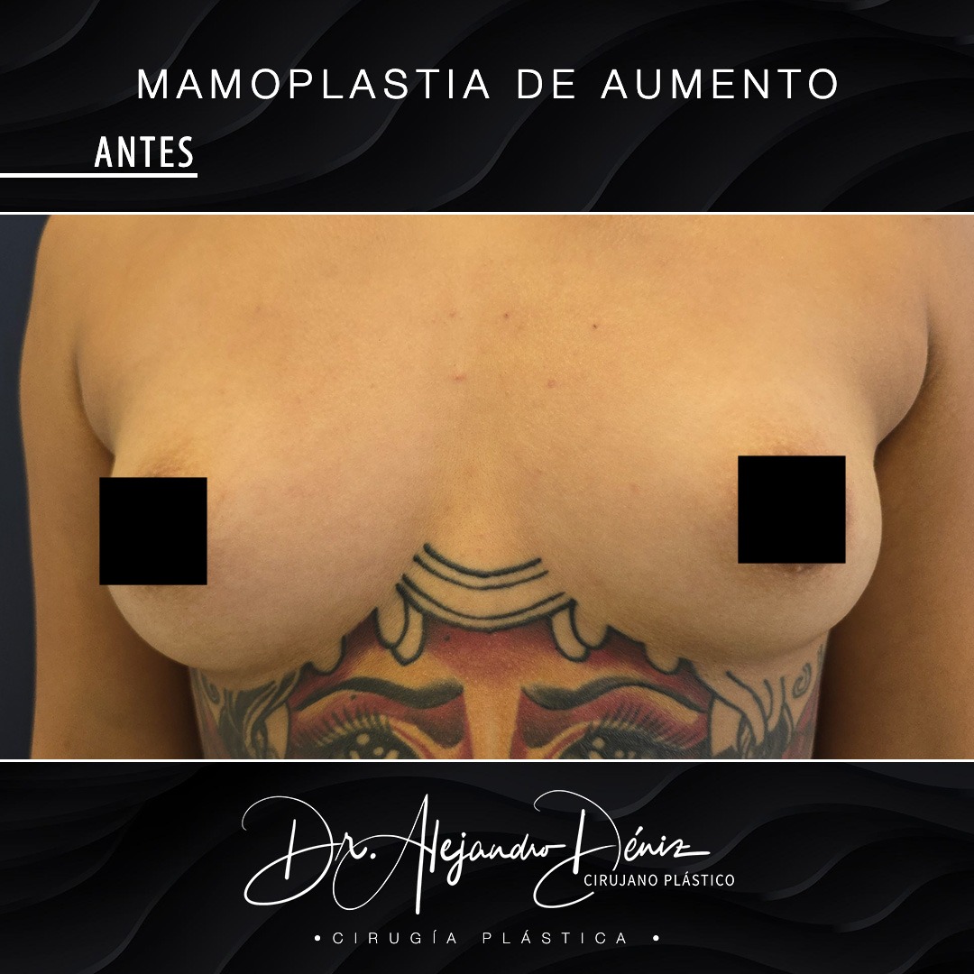 MAMOPLASTIA DE AUMENTO_9