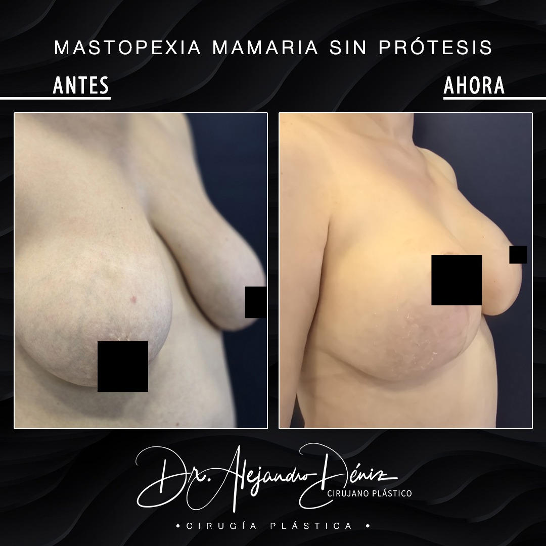 MASTOPEXIA MAMARIA SIN PROTESIS_1